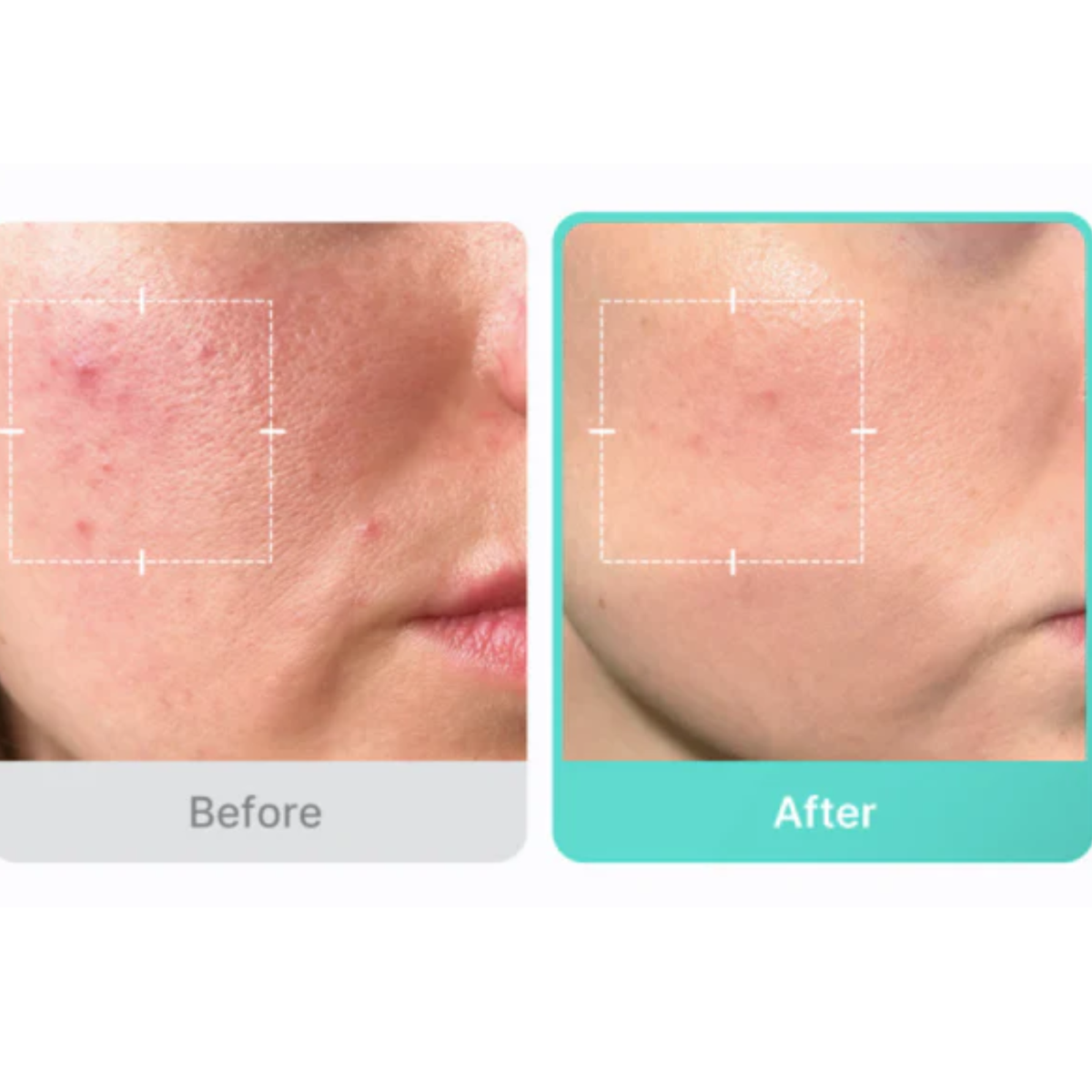 Medicube Azelaic Acid 16% Serum