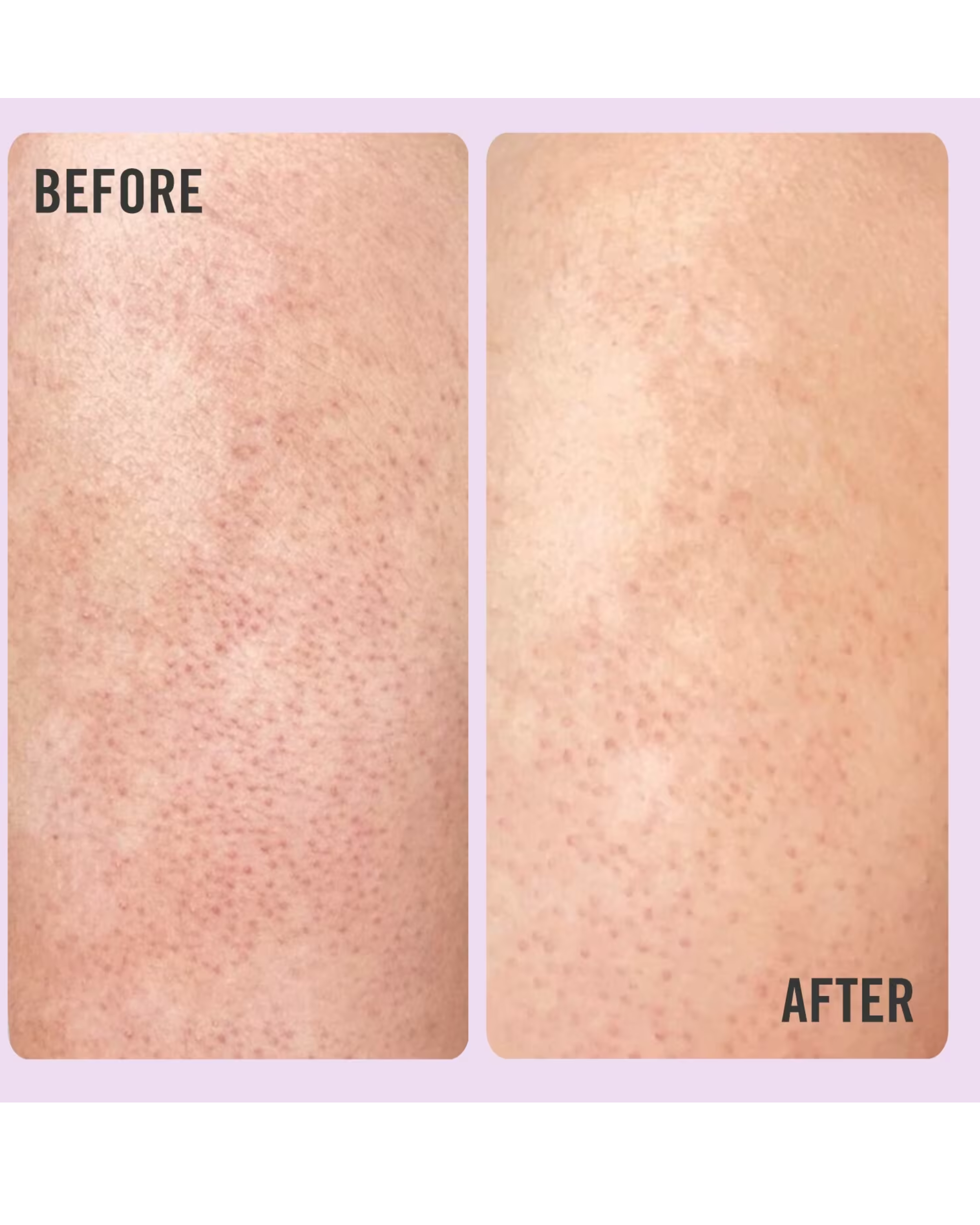 First Aid Beauty Bump Eraser Body Scrub