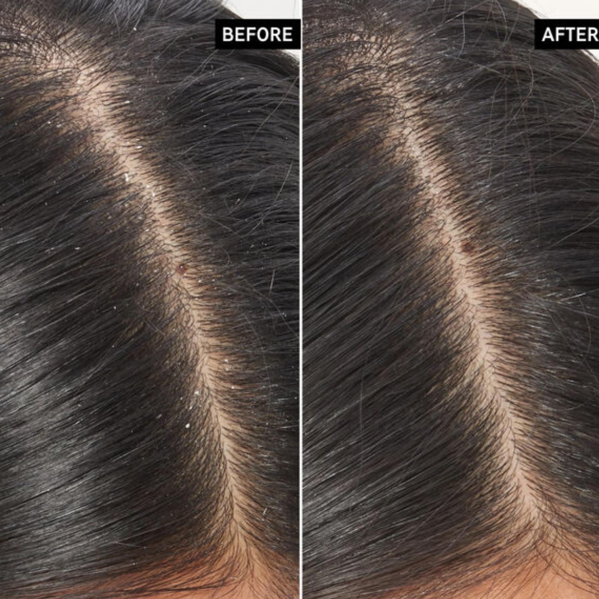 The Inkey List  Salicylic Acid Exfoliating Scalp Treatment